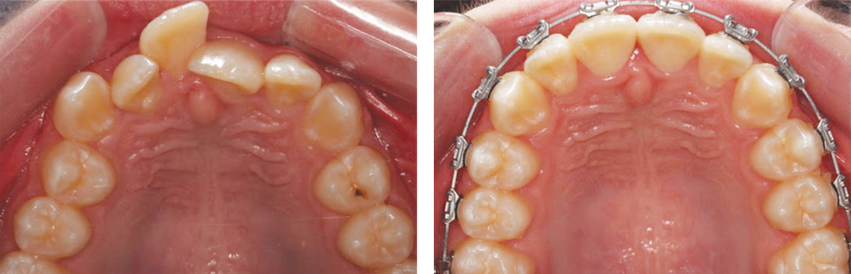 Fast Braces Before and After