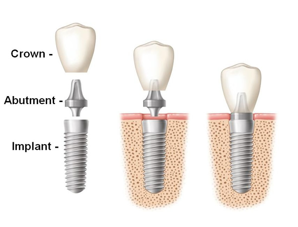 Dental Implants - Sacramento, CA