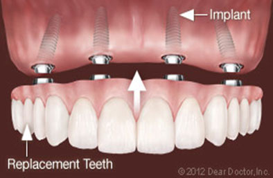 Implant Supported Full Mouth Reconstruction