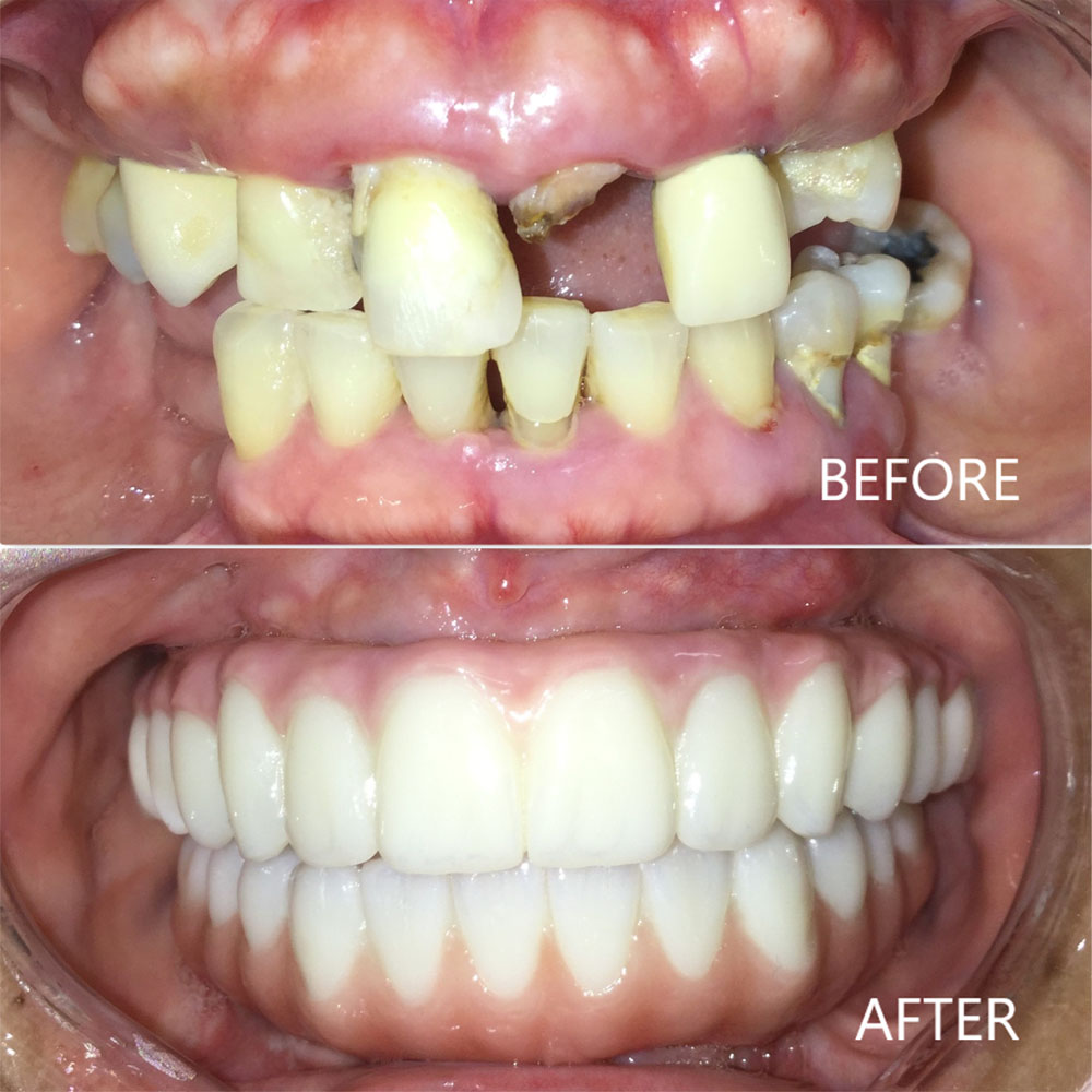 Full Upper Denture and Partial Lower Denture along with 2 Cerec Crown Restorations