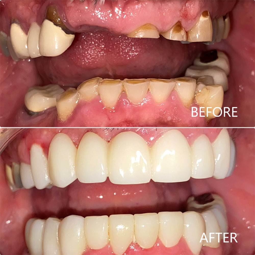 Veneers and Partial Upper and Lower Dentures