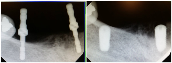 2 Implants placed in less than 2 hours!